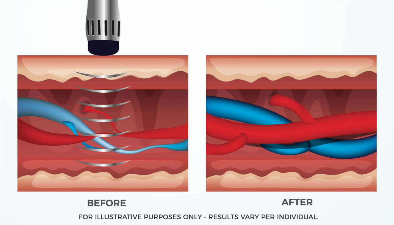 Shockwave Therapy For Erectile dysfunction - Innovative Men's Health