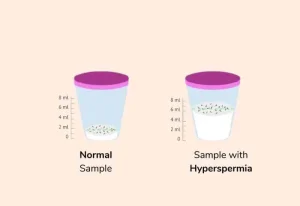 Hyperspermia