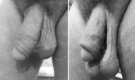 Scrotox_Before_And_After_Picture