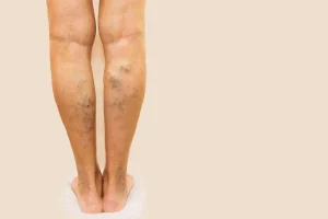 Varicose Veins
