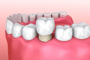 8 Reasons You Need a Ceramic Crown