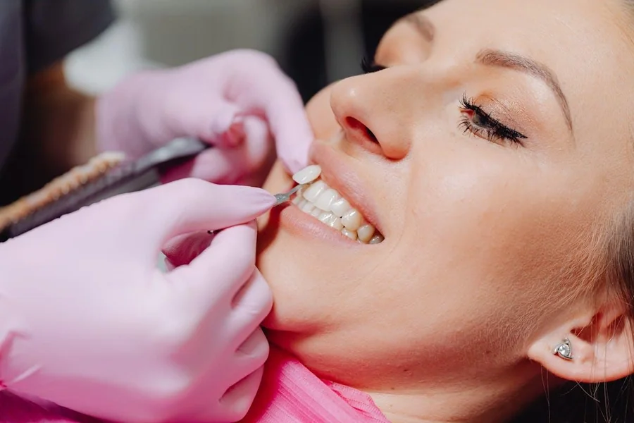 Composite Veneers