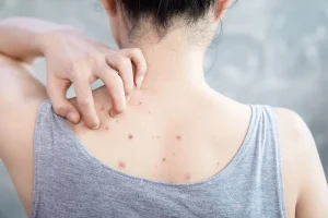 Understanding Back Acne and Why It Happens