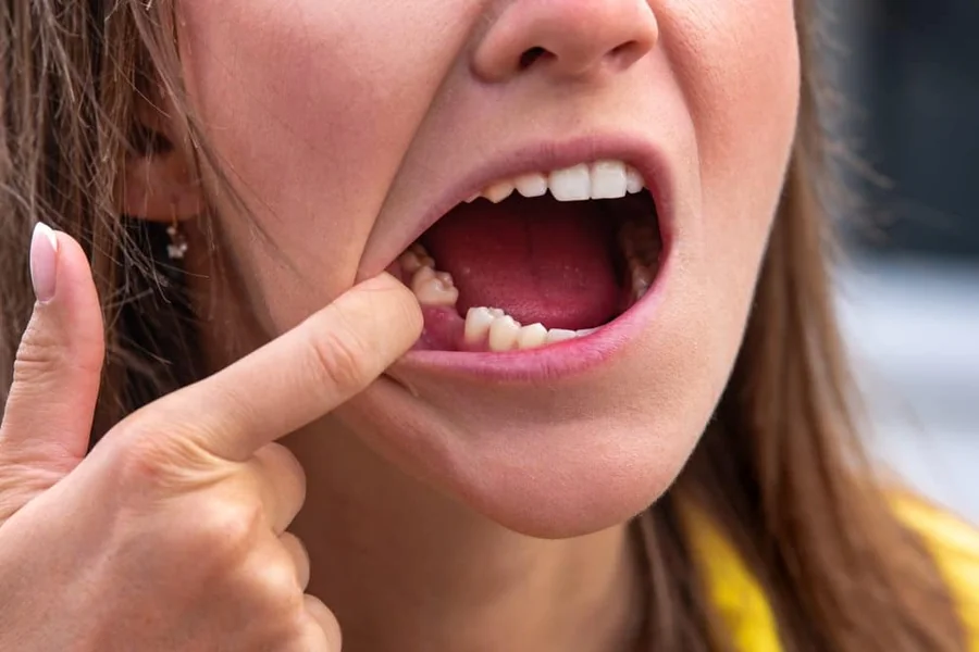 Granulation Tissue After Tooth Extraction Pictures, Healing Stages & What’s Normal