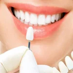 Porcelain Veneers in Irvine Costs, Process & What to Expect (2026 Guide)