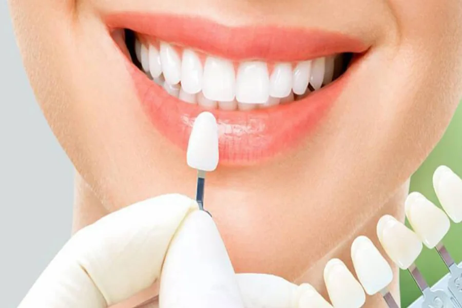 Porcelain Veneers in Irvine Costs, Process & What to Expect (2026 Guide)