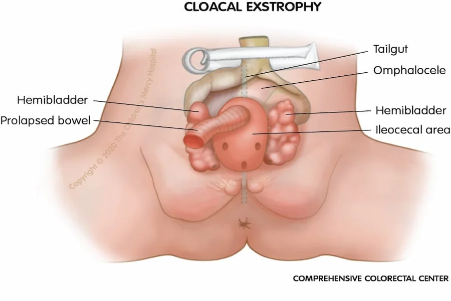 Real Cloacal Exstrophy Pictures