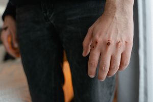 Wounds