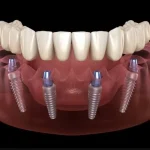 Implants