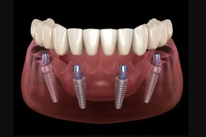 Implants
