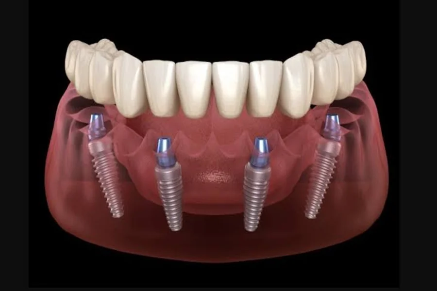 Implants
